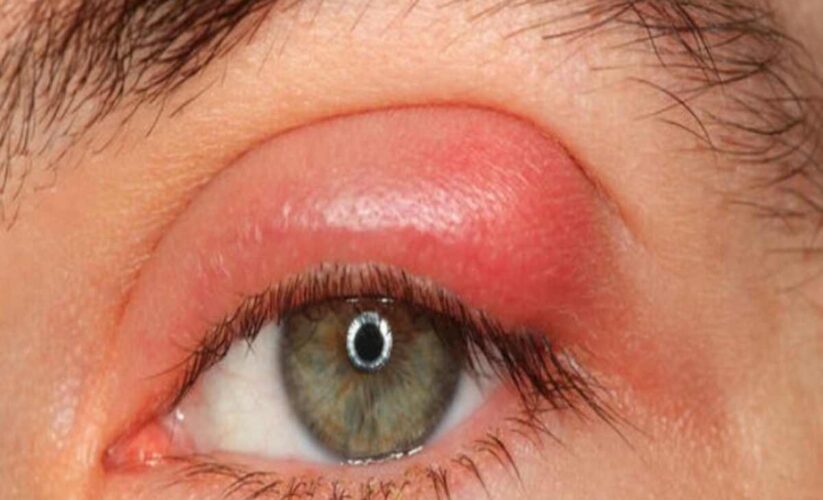 Terçol Anti-Inflamatórios Não Esteroides: Stye Medication